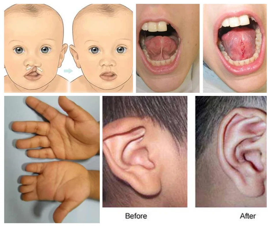 Congenital Deformities